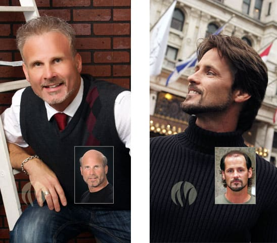 mens hair restoration replacement minneapolis minnesota