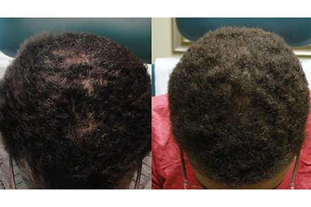 Men's PRP Hair Hair Restoration Therapy - Hair Restoration Institute