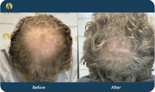 Exosome Results after 1 treatment