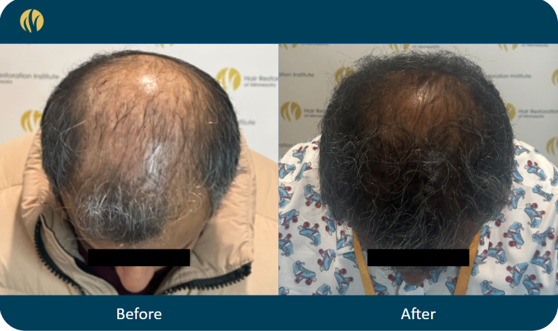 EV Pure 6 Months Result