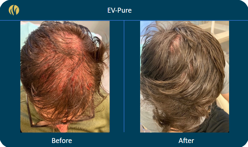 EV Pure 6 Months Result