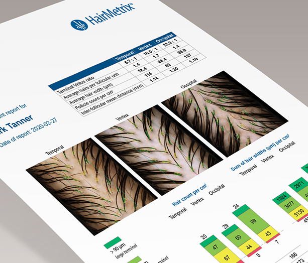 HairMetrix scalp analysis for women with thinning hair