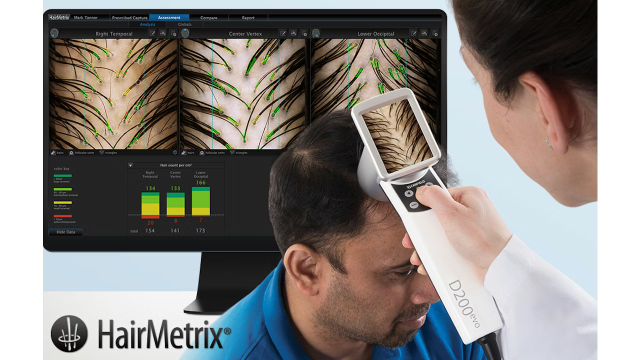 HairMetrix consultation for men with hair loss in Minnesota