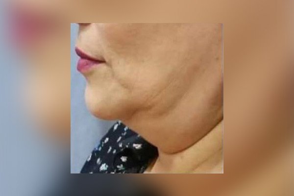 ELIMINACIÓN DE PAPADA - ANTES