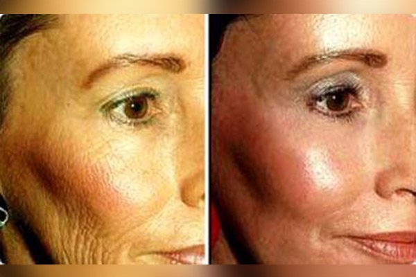 PEELING DE MEDIANA INTENSIDAD