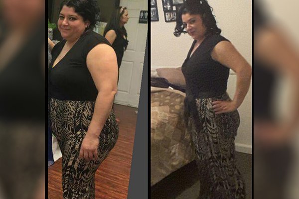 ELIMINACIÓN DE PAPADA - ANTES