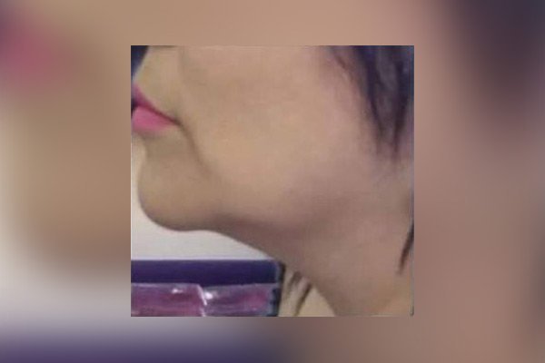 ELIMINACIÓN DE PAPADA - ANTES