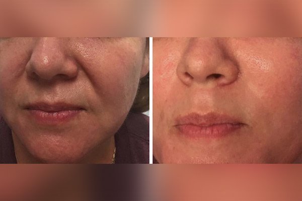 ELIMINACIÓN DE PAPADA - ANTES