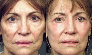 Laser Skin Resurfacing