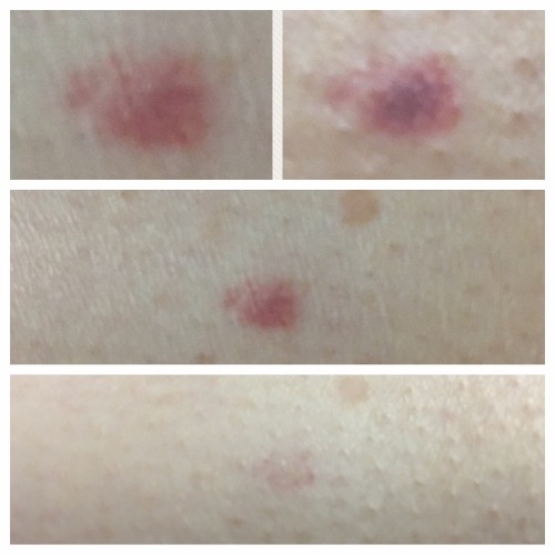 Laser Birthmark Removal