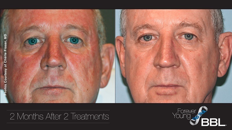 BBL Rosacea Treatment