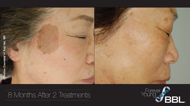 BBL for Hyperpigmentation