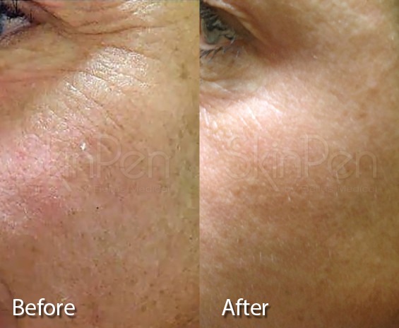 Skin Pen Microneedling